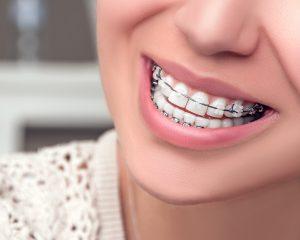 Fremont CA Orthodontic Braces